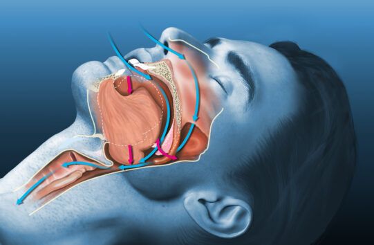 Beyond Snoring: Sleep Apnea’s Surprising Impact on Your Mental Wellness