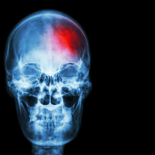 sign of stroke in brain